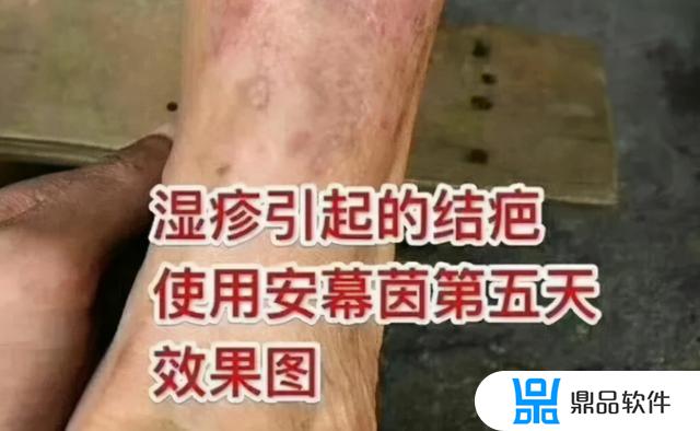 抖音上治疗腰突的喷剂怎么样